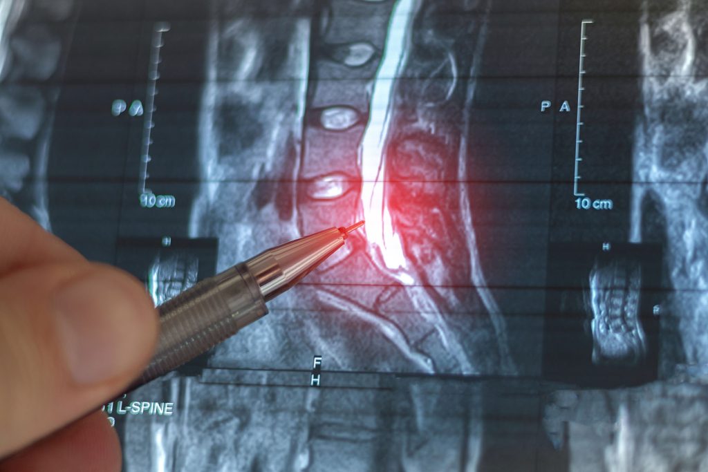 Doctor learning MRI of the lumbar spine. At level 12, an arachn